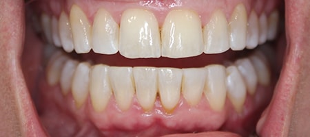 Before and After Invisalign Treatment Milton Keynes
