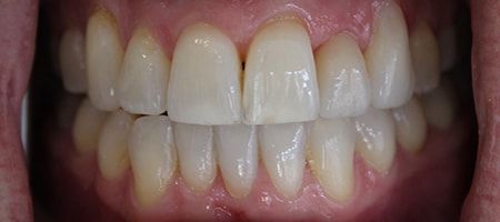 Before and After Invisalign Treatment Milton Keynes