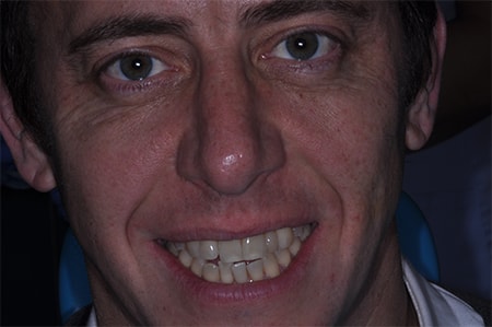 Before and After Invisalign Treatment Milton Keynes
