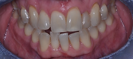 Before and After Invisalign Treatment Milton Keynes