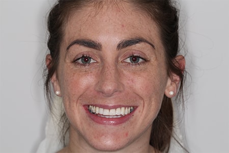 Before and After Invisalign Treatment Milton Keynes