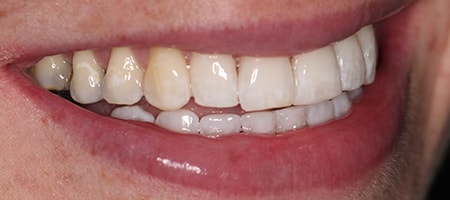 Before and After Invisalign Treatment Milton Keynes