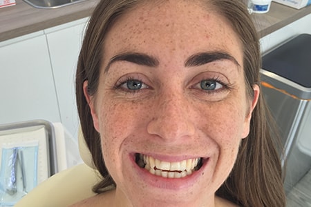 Before and After Invisalign Treatment Milton Keynes