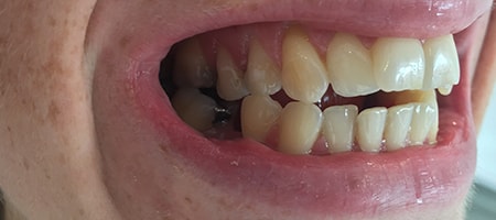 Before and After Invisalign Treatment Milton Keynes