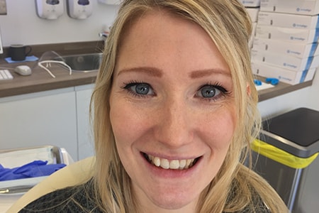 Before and After Invisalign Treatment Milton Keynes