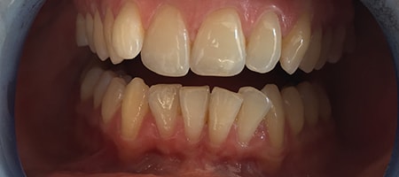 Before and After Invisalign Treatment Milton Keynes