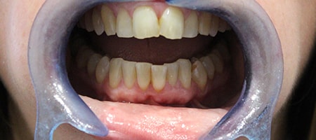 Before and After Invisalign Treatment Milton Keynes