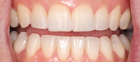 Before and After Invisalign Treatment Milton Keynes