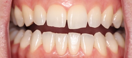 Before and After Invisalign Treatment Milton Keynes