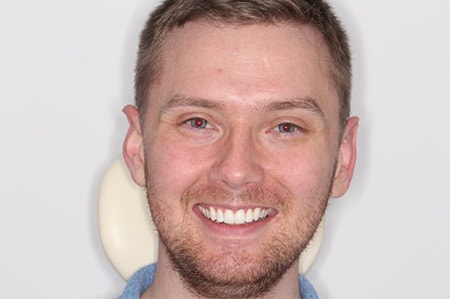 Before and After Invisalign Treatment Milton Keynes