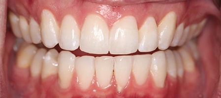Before and After Invisalign Treatment Milton Keynes