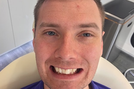 Before and After Invisalign Treatment Milton Keynes