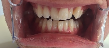 Before and After Invisalign Treatment Milton Keynes