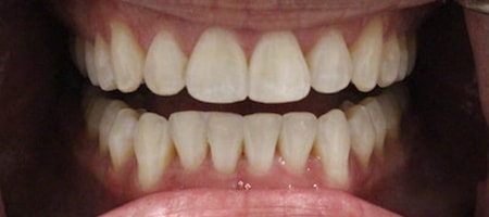 Before and After Invisalign Treatment Milton Keynes