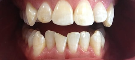 Before and After Invisalign Treatment Milton Keynes