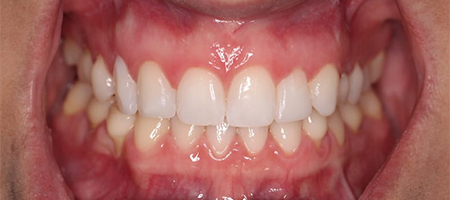 Before and After Invisalign Treatment Milton Keynes