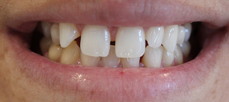Before and After Invisalign Treatment Milton Keynes