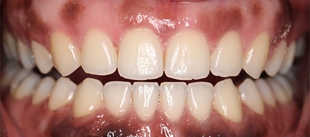 Before and After Invisalign Treatment Milton Keynes