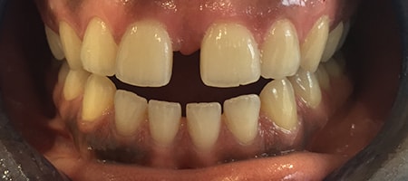 Before and After Invisalign Treatment Milton Keynes