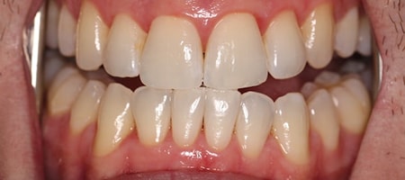 Before and After Invisalign Treatment Milton Keynes