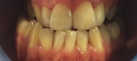 Before and After Invisalign Treatment Milton Keynes