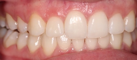 Before and After Invisalign Treatment Milton Keynes