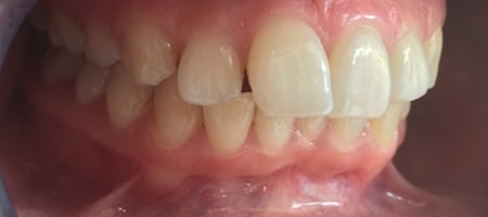 Before and After Invisalign Treatment Milton Keynes