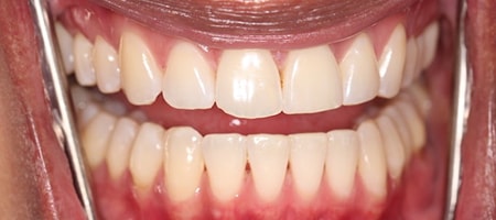 Before and After Invisalign Treatment Milton Keynes