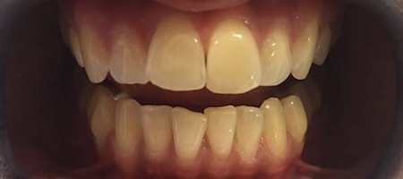 Before and After Invisalign Treatment Milton Keynes