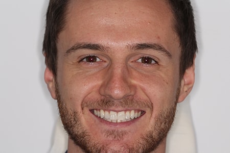 Before and After Invisalign Treatment Milton Keynes