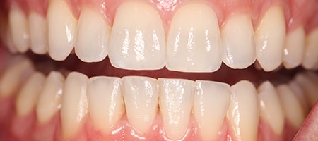 Before and After Invisalign Treatment Milton Keynes
