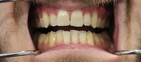 Before and After Invisalign Treatment Milton Keynes