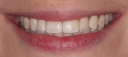 Before and After Invisalign Treatment Milton Keynes