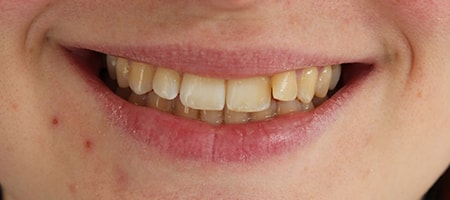 Before and After Invisalign Treatment Milton Keynes
