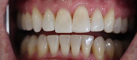 Before and After Invisalign Treatment Milton Keynes
