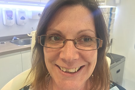 Before and After Invisalign Treatment Milton Keynes