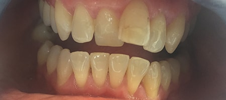 Before and After Invisalign Treatment Milton Keynes