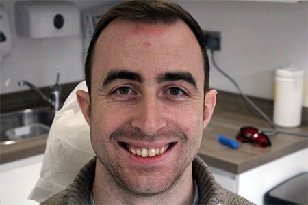 Before and After Invisalign Treatment Milton Keynes