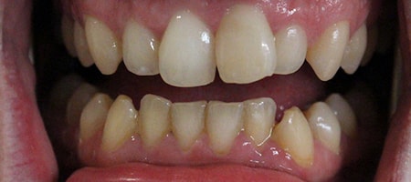 Before and After Invisalign Treatment Milton Keynes