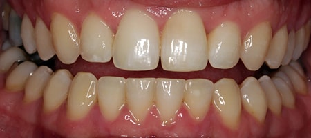 Before and After Invisalign Treatment Milton Keynes
