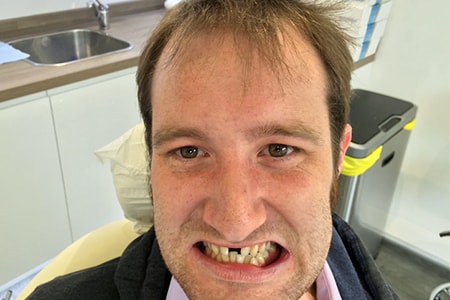 Before and After Invisalign Treatment Milton Keynes