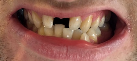 Before and After Invisalign Treatment Milton Keynes