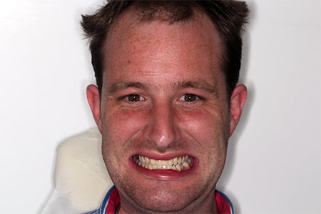 Before and After Invisalign Treatment Milton Keynes