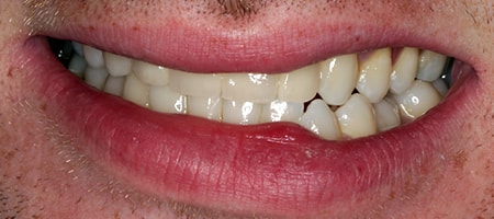 Before and After Invisalign Treatment Milton Keynes