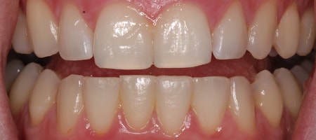Before and After Invisalign Treatment Milton Keynes