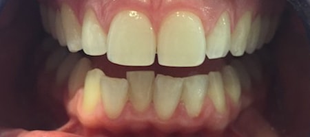 Before and After Invisalign Treatment Milton Keynes