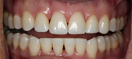 Before and After Invisalign Treatment Milton Keynes