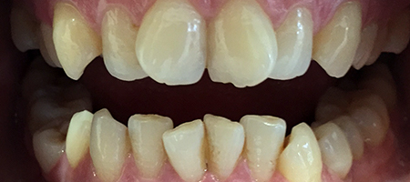 Before and After Invisalign Treatment Milton Keynes