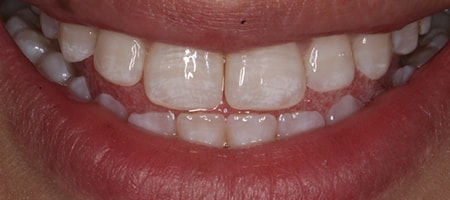 Before and After Invisalign Treatment Milton Keynes