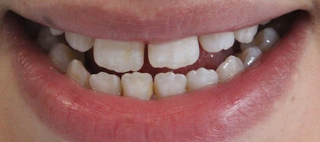 Before and After Invisalign Treatment Milton Keynes